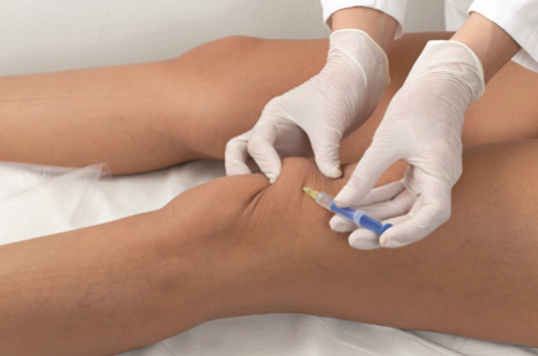 injection above the knee for ozone therapy
